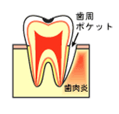 プラークコントロール